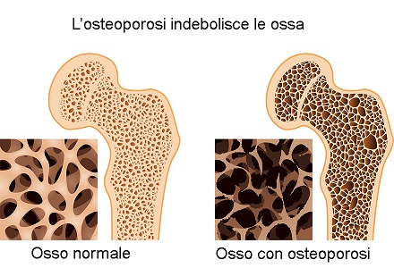 osteoporosi