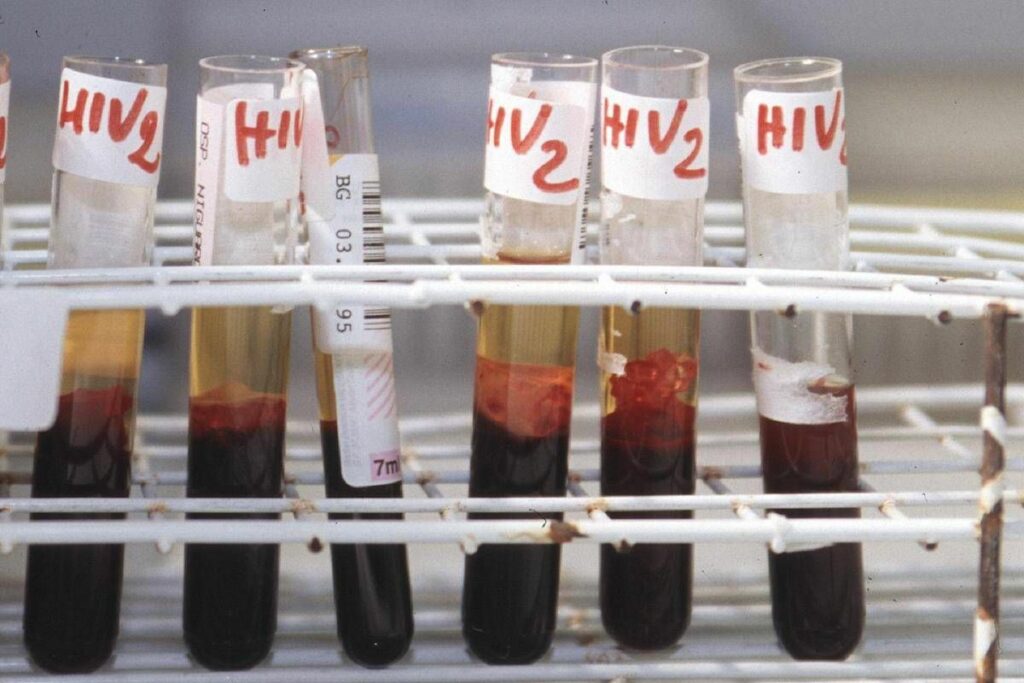 Aids scoperti codici del sistema immunitario per sospendere le cure
