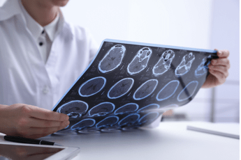 Sclerosi multipla neurologi Con nuovi strumenti la diagnosi sempre piu precoce Sclerosi multipla neurologi Con nuovi strumenti la diagnosi sempre piu precoce