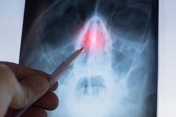 Rinosinusite cronica con poliposi nasale lotorino Con biologici verso remissione Rinosinusite cronica con poliposi nasale lotorino Con biologici verso remissione