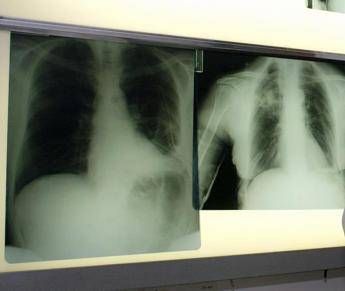 Cancro polmone a piccole cellule ok Ue a tislelizumab