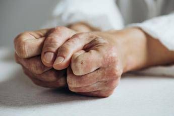 Lo studio inibitore Il 23 riduce segni e sintomi artrite psoriasica attiva Lo studio inibitore Il 23 riduce segni e sintomi artrite psoriasica attiva