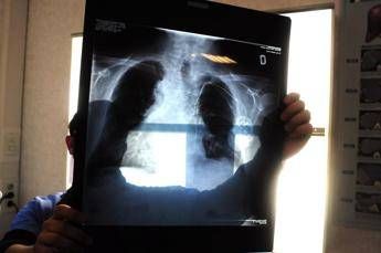 Tumori in carcinoma polmonare risultati positivi da combinazione in prima linea Tumori in carcinoma polmonare risultati positivi da combinazione in prima linea