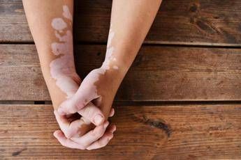 Estate vitiligine e sole le regole per una abbronzatura sicura